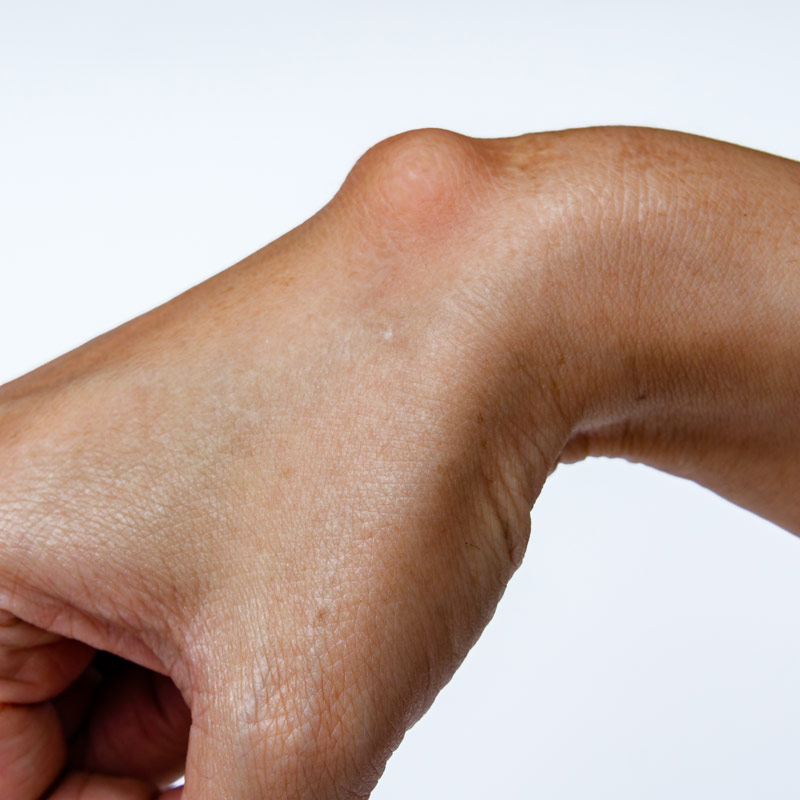 Medical Services - Cysts