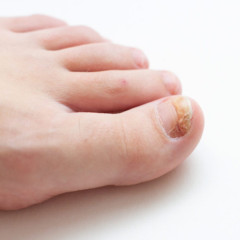 Medical Services - Nail Disease