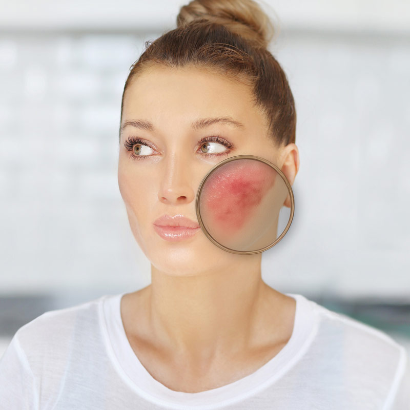 Medical Services - Rosacea