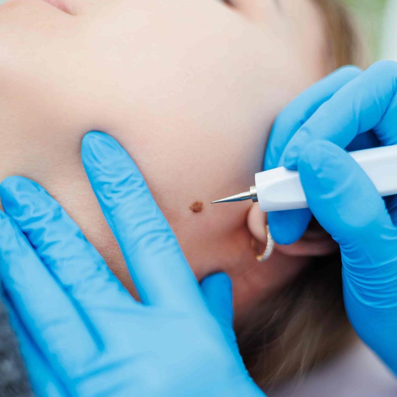 Medical Services - Benign Lesions